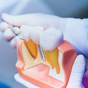 The image shows a dental model with an open mouth and visible teeth, being worked on by a person wearing gloves and a surgical mask.