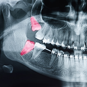 The image shows a close-up view of a human skull with a focus on the oral cavity, featuring visible teeth and pink tongue, with an emphasis on a red object that appears to be a surgical implant or tool in the lower jaw area.